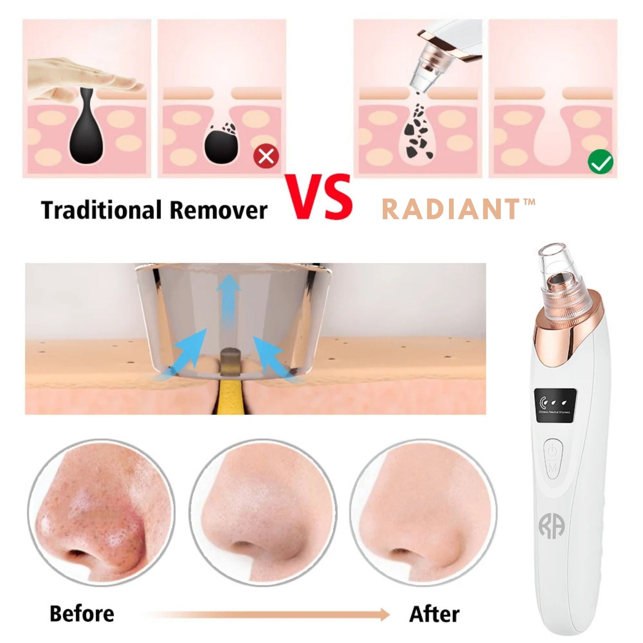 Radiant™ Skin Blackhead Remover