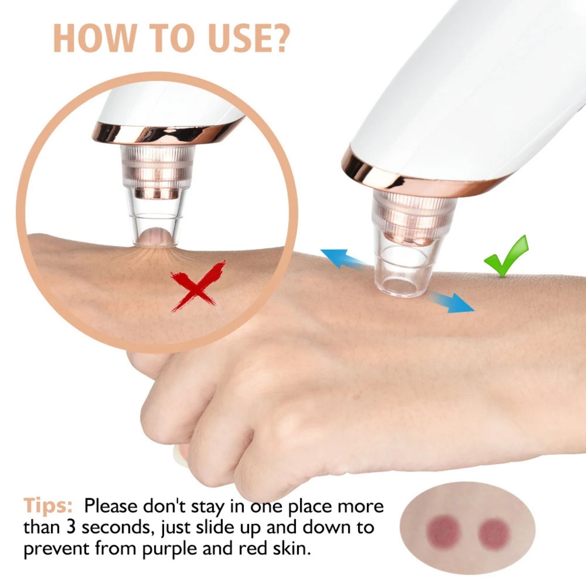 Radiant™ Skin Blackhead Remover