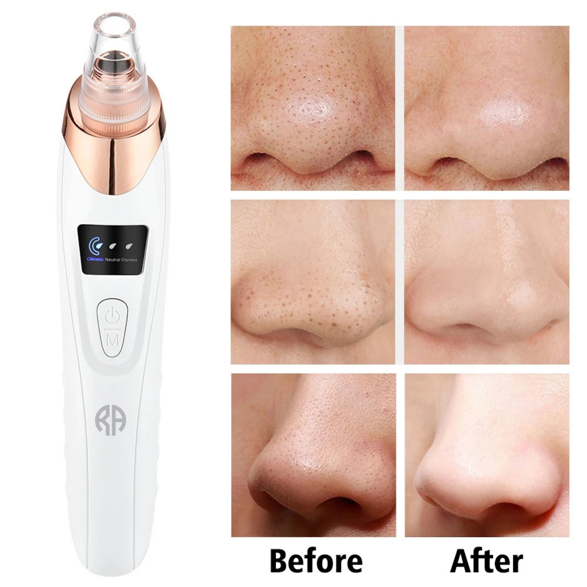 Radiant™ Skin Blackhead Remover